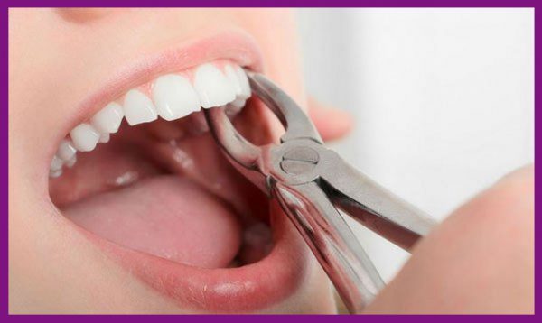 ghép xương có thể được thực hiện sau nhổ răng từ 3 đến 5 tháng