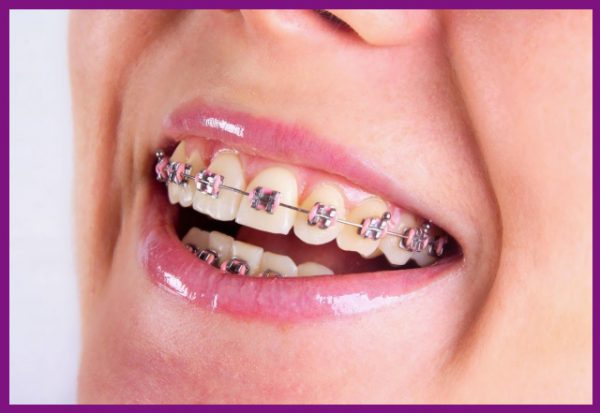 niềng răng là biện pháp hữu hiệu để nắn chỉnh răng sai lệch về đúng vị trí