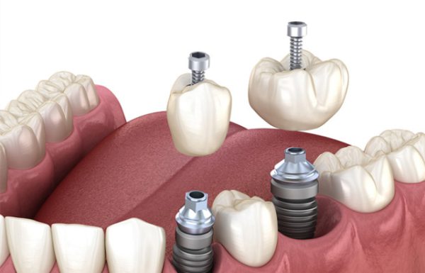 Hình ảnh cắm implant mô tả quy trình trồng răng chuẩn và an toàn