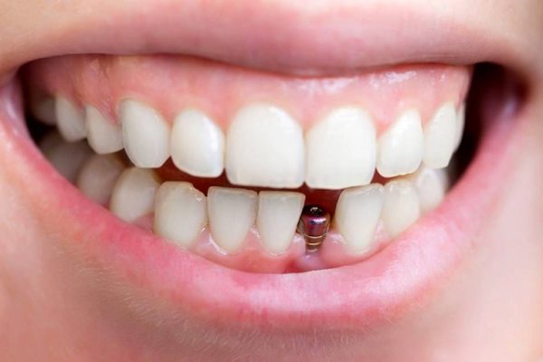 thời gian trồng răng Implant nhanh