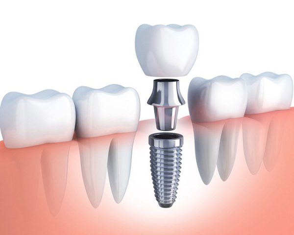 implant hàn quốc có tốt không