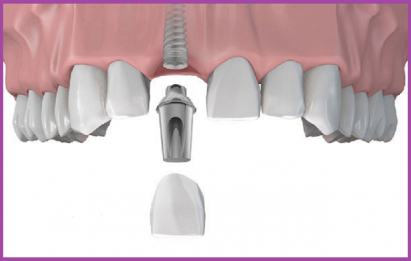 dịch vụ implant răng cửa d