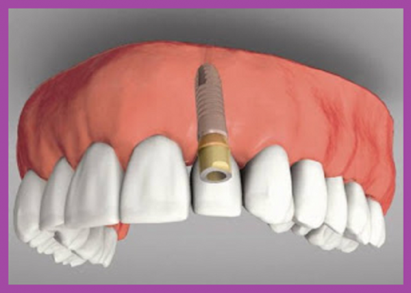 implant răng cửa chất lượng