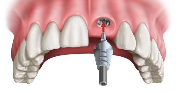 implant răng cửa