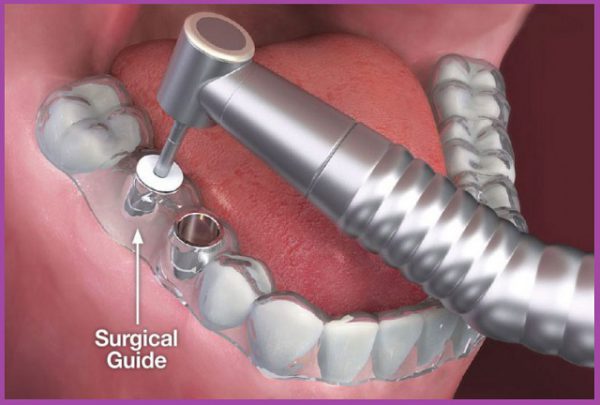 Kỹ thuật trồng răng implant 3D Guide