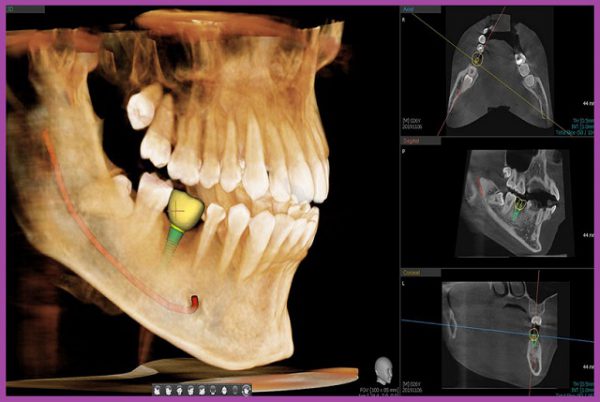 Kỹ thuật trồng răng implant Immediate Loading