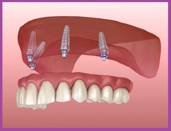 kỹ thuật cấy răng implant All – On – 4
