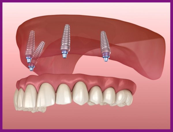 trồng răng implant sẽ giúp ngăn ngừa quá trình tiêu xương xảy ra