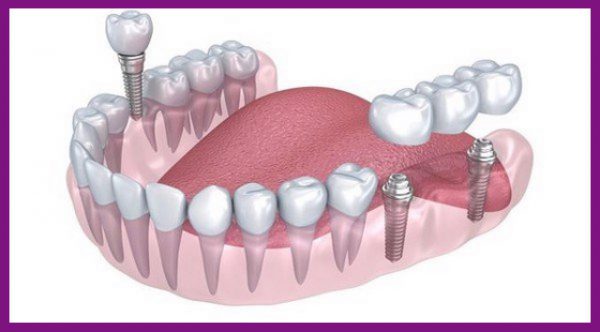 trụ implant sẽ đóng vai trò là chân răng thật