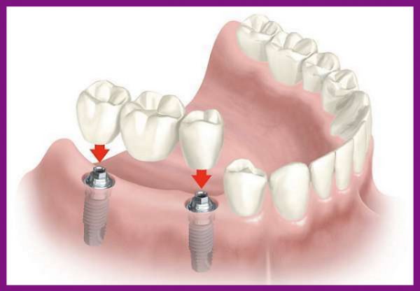 trồng răng implant ngăn chặn tình trạng tiêu xương hàm xảy ra