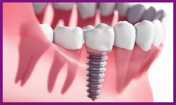 Trồng răng implant là kỹ thuật phục hồi răng hiện đại nhất hiện nay