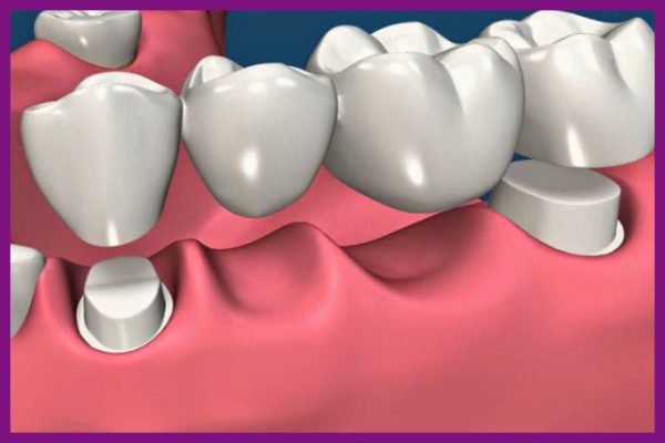 Cầu răng sứ gây tổn hại đến răng kế cạnh