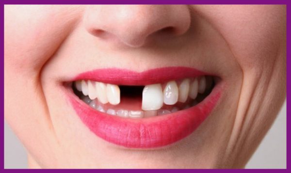 Kỹ thuật trồng răng implant phù hợp với nhiều bệnh nhân đang có tình trạng mất răng