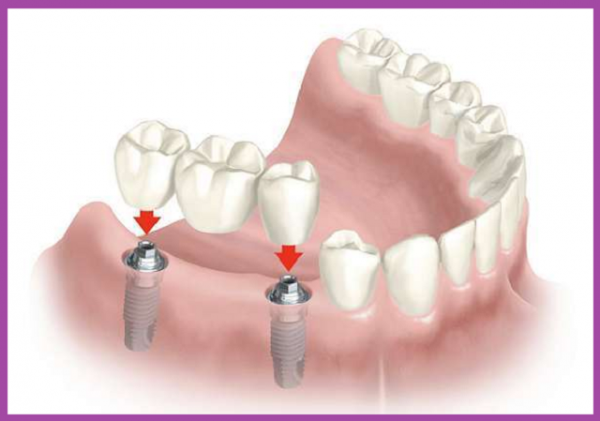 lắp răng implant uy tín