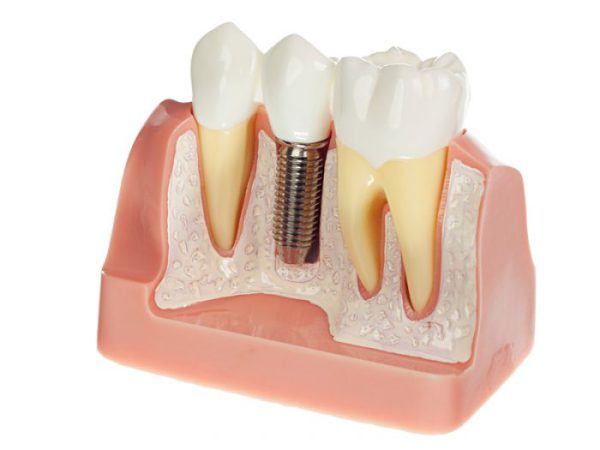 lắp răng implant