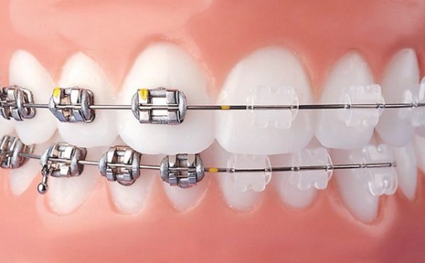 Tìm hiểu phương pháp niềng răng mắc cài tự buộc và mắc cài thường