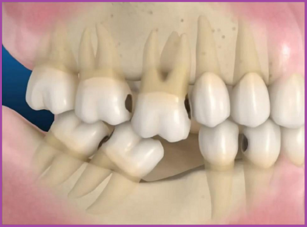 ảnh hưởng mất răng hàm lâu năm 