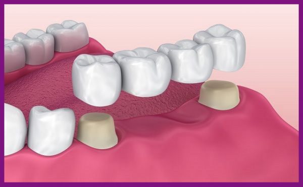 có thể chọn làm cầu răng sứ để khôi phục chức năng của răng số 6