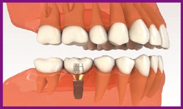 trồng răng implant là biện pháp thay thế trong trường hợp không niềng được khi mất răng số 6