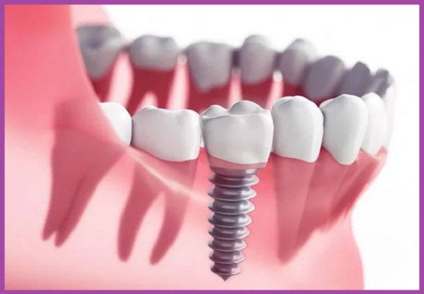phương pháp trồng răng cấy ghép Implant