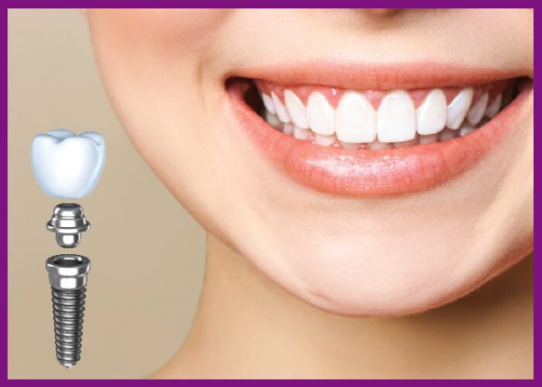 trồng răng implant mang lại rất nhiều lợi ích thiết thực cho bệnh nhân mất răng