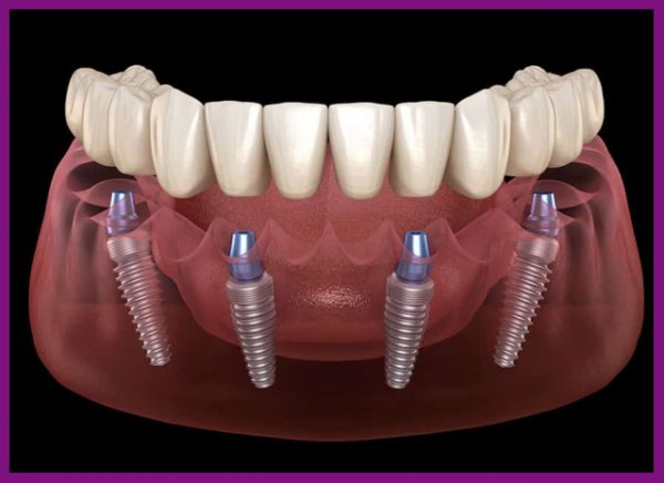 trồng răng implant phải đảm bảo không được xảy ra sai sót
