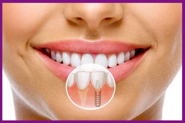 trồng răng implant đòi hỏi sự chính xác rất cao và rất khó thực hiện
