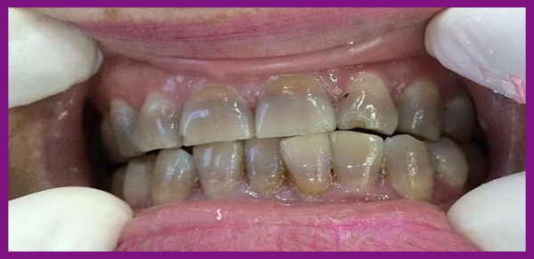 Răng bị nhiễm màu tetracyline