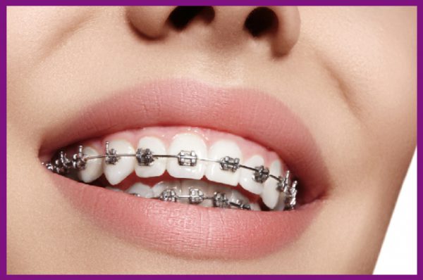 niềng răng là biện pháp nắn chỉnh răng hiệu quả nhất hiện nay