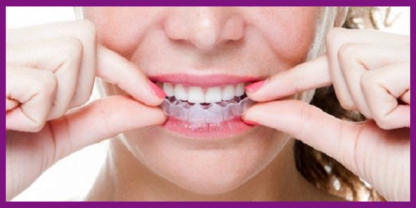niềng răng invisalign có thể áp dụng cho mọi tình trạng răng mọc lệch lạc khác nhau