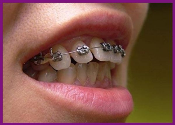 niềng răng là biện pháp nắn chỉnh răng về đúng vị trí hiệu quả nhất hiện nay