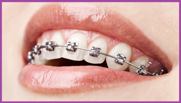 thực tế niềng răng bằng silicon có hiệu quả không 