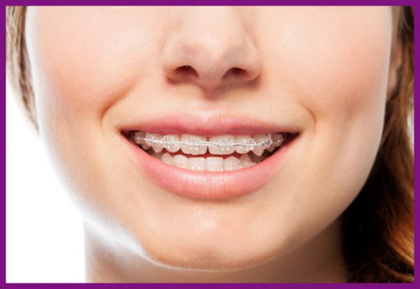 niềng răng là biện pháp chỉnh nha được nhiều người chọn lựa nhất hiện nay