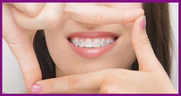 niềng răng giúp nắn chỉnh các khớp răng về lại đúng vị trí