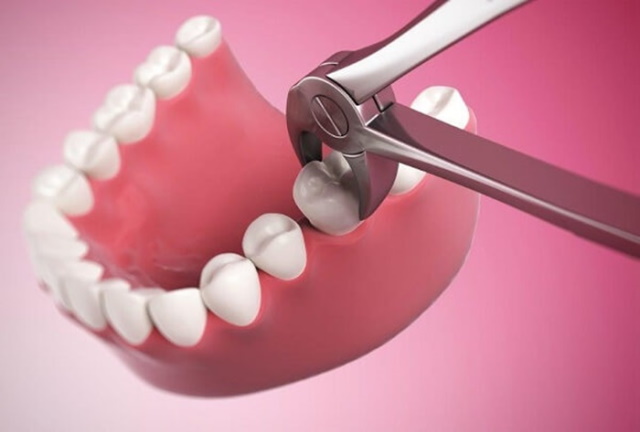 Tìm hiểu xem liệu niềng răng có phải nhổ răng khôn không?