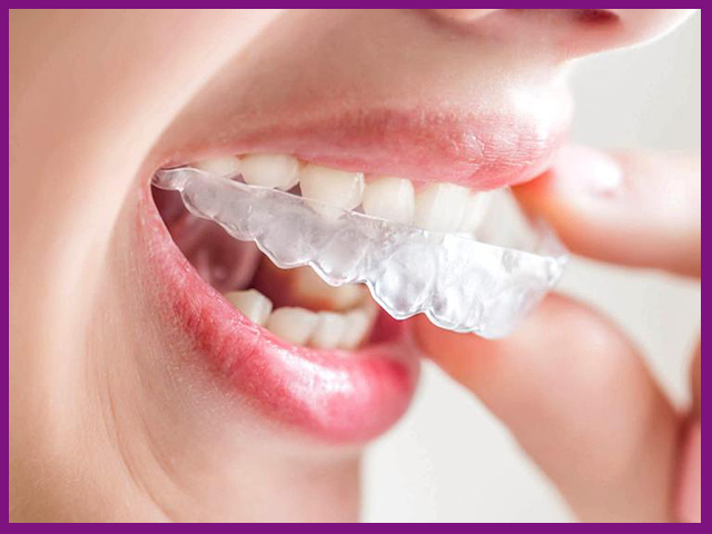 Niềng răng không mắc cài 3D Clear dễ vệ sinh