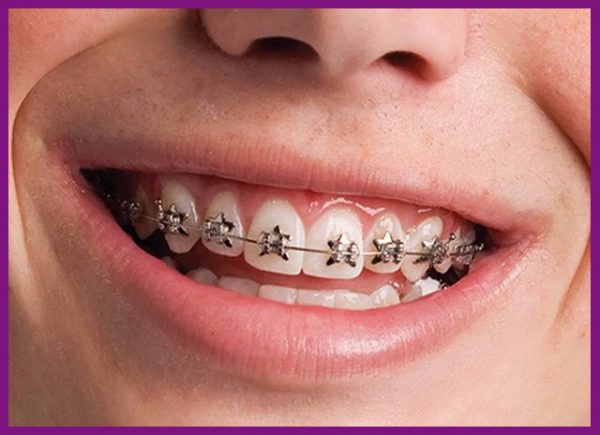 niềng răng là biện pháp nắn chỉnh răng được ưa chuộng nhất hiện nay