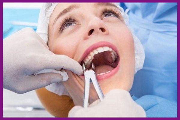 cần chọn nha khoa uy tín để thực hiện niềng răng nhổ răng số 4