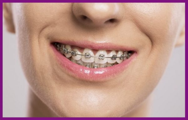 niềng răng là biện páp hữu hiệu để nắn chỉnh răng về đúng vị trí