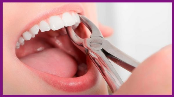 việc nhổ răng số 4 không gây hại gì đến sức khỏe răng miệng