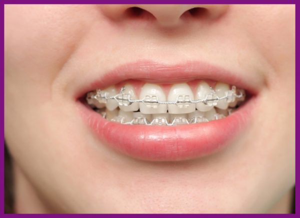xác định tình trạng răng miệng để niềng răng nhổ răng số 4 được an toàn hơn