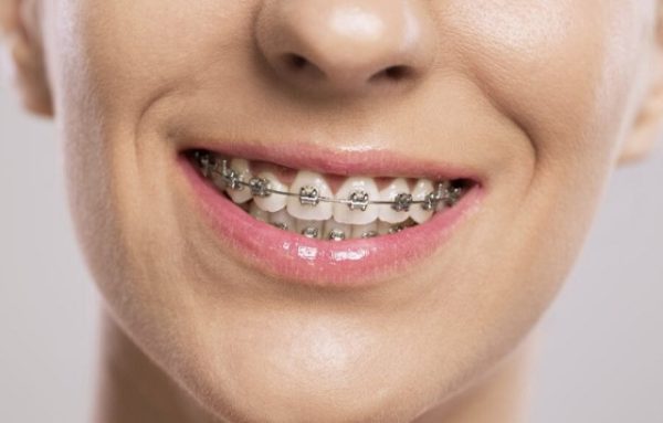 Làm sao để hạn chế nguy hiểm khi niềng răng nhổ răng số 4 ?