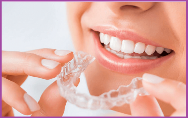 niềng răng trong suốt clear aligner đẹp