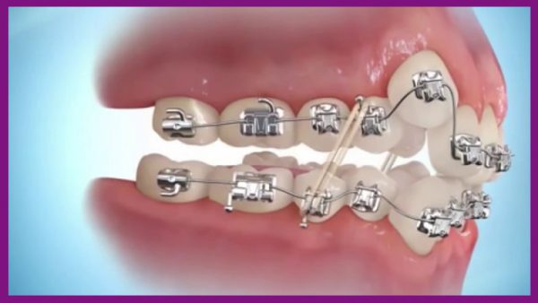 quá trình niềng răng mất bao lâu còn tùy thuộc vào mức độ răng lệch lạc của từng người