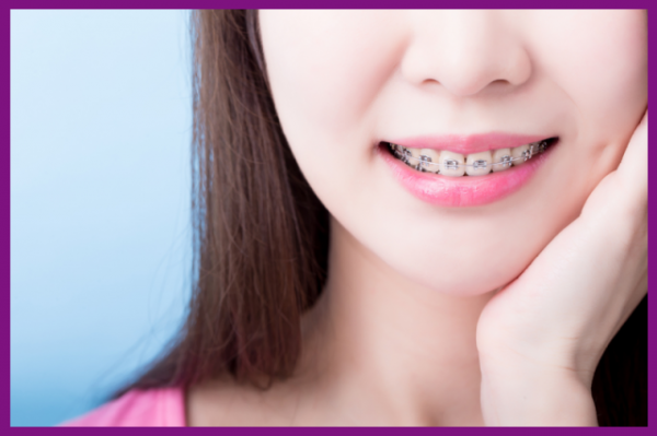thời gian niềng răng trung bình từ 12 đến 24 tháng
