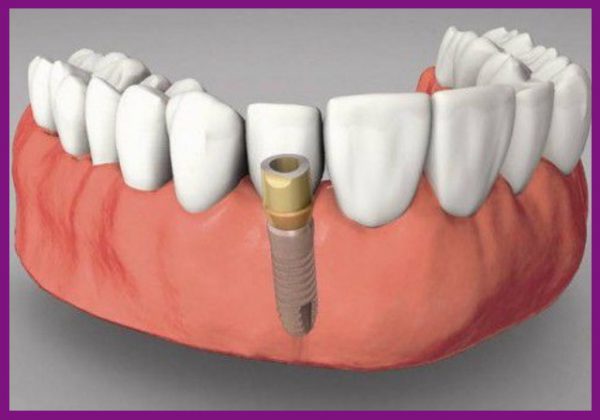 trồng răng implant phục hồi chức năng ăn nhai rất tốt
