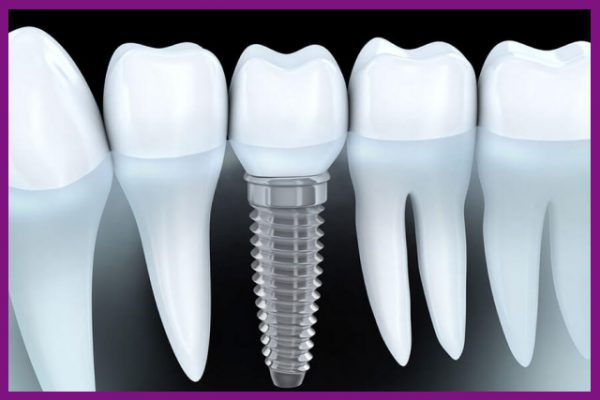 cấy ghép implant là biện pháp phục hồi răng hiện đại nhất hiện nay