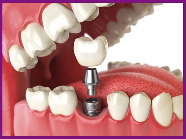 trồng răng implant vinhan chất lượng
