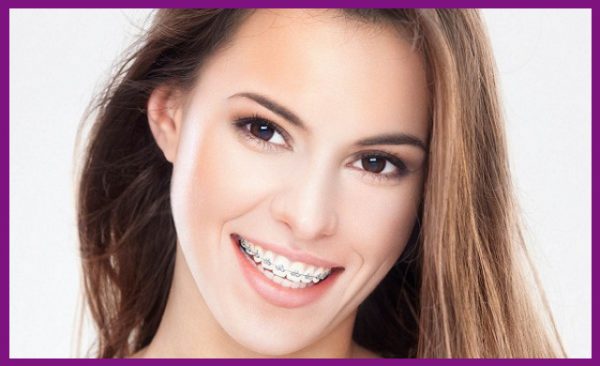 niềng răng là biện pháp chỉnh nha mang lại hàm răng đẹp mỹ mãn