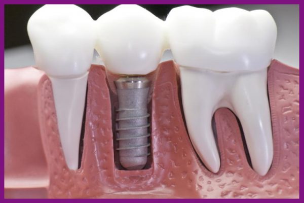 trụ implant đóng vai trò là chân răng thật